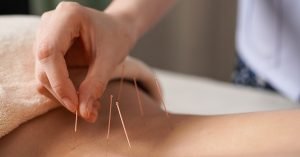 Woman Receiving Acupuncture on her lower back from Eastwest Integrated Care